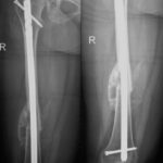 X Ray View Of Femur Fracture And Treatment