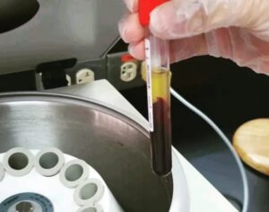 serum plasma seperation centrifugation